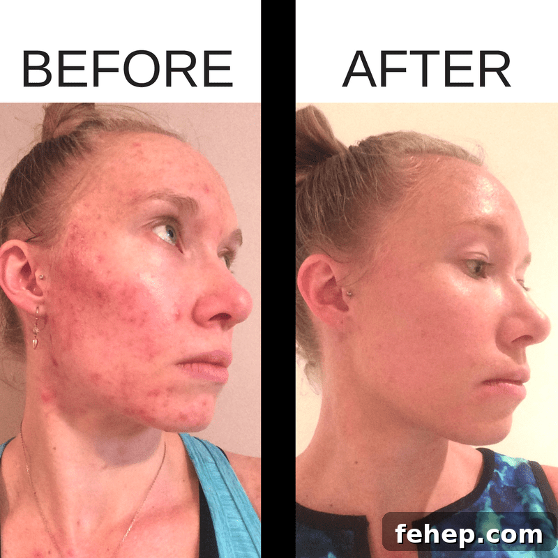 Before and after acne photos after using Beautycounter products. 